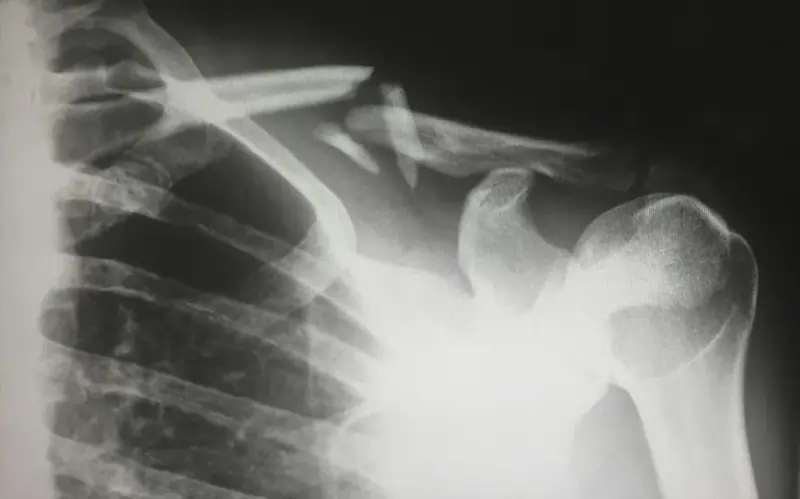 An x-ray image of a persons ribcage.